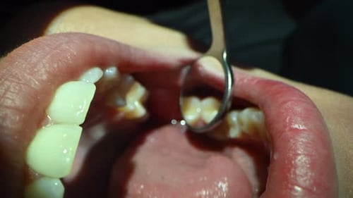 Dental Care Extreme Close Up Macro Video Dentist Treat Patient Teeth Orthodontist Works with