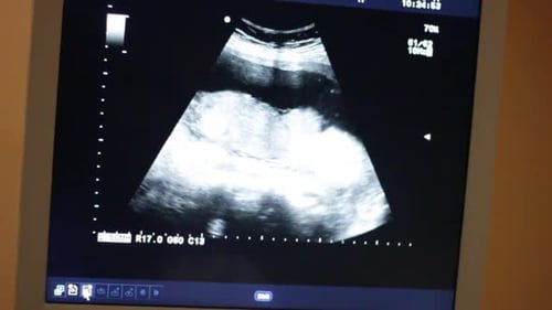 doctor pointing an a ultrasound monitor