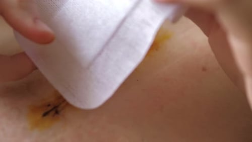 Abdomen of Young Girl Closeup Video of Girl's Hand is Changing Bandage After the Abdominal Surgery