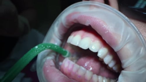 Dental Extreme Close Up Macro Video Dental Cleaning Process in Patient Mouth Clean Teeth with Water