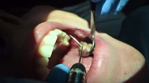 Dental Care Extreme Close Up Macro Video Dentist Treat Patient Teeth Orthodontist Works with