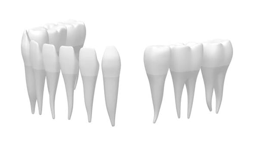 3D Dental Implant Animation Showing Tooth Replacement Process