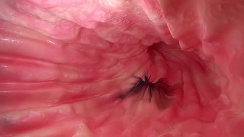 Medical animation of a tumor growing inside human intestinal tissue
