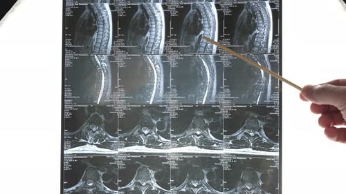Hand Points to Details on Spine MRI Scan
