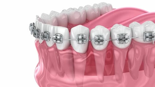 3D Medical Animation of Dental Braces on Jaw and Teeth