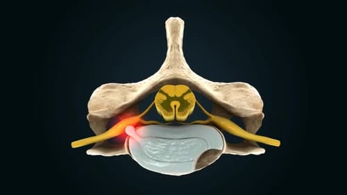 Spinal Disc Compression and Nerve Impingement Animation