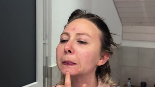Disappointed Woman Looking at Acne in Mirror Skin Problem