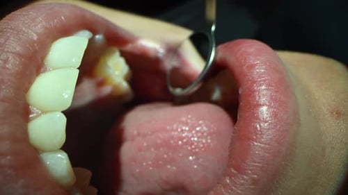 Dental Care Extreme Close Up Macro Video Dentist Treat Patient Teeth Orthodontist Works with
