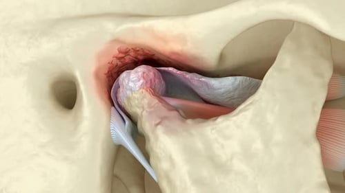 3D Animation of Temporomandibular Joint Dysfunction and Inflammation