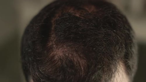 Man with early hair loss on the crown and temples applies oil and uses a derma roller