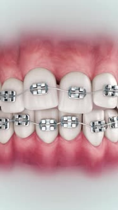 Brackets Up 9x16 004