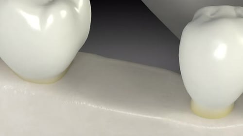 3D Animation of Dental Implant Procedure