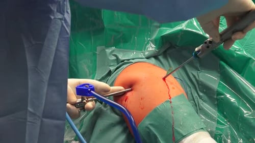 Knee Arthroscopy Surgical Procedure in Hospital Operating Room