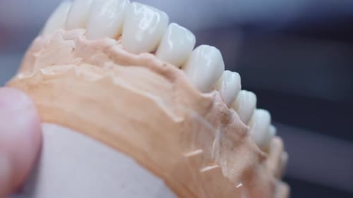 Artificial Teeth Veneers in a Medical Setting