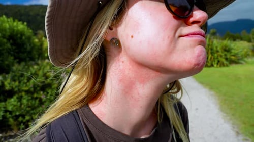 Female explorer suffering from dermatitis irritation on neck skin