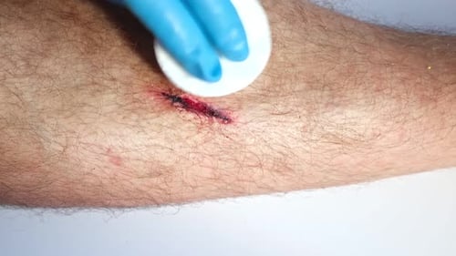 The Wound on a Leg of Young Man