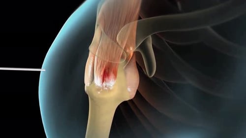 Medical Animation of Arthroscopic Rotator Cuff Surgery