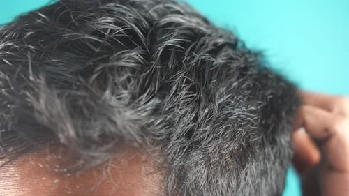 Itchy Scalp and Dandruff Extreme Close Up