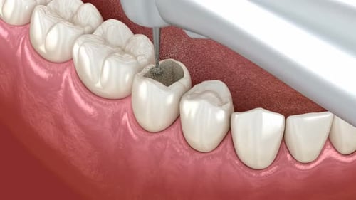 Premolar tooth restoration with composite filling