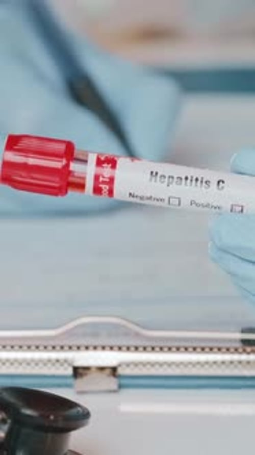 Positive Hepatitis C Blood Test Marked by Doctor