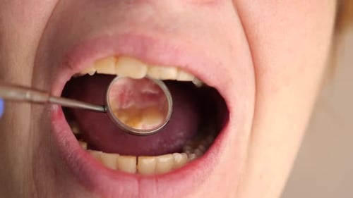 Open Mouth During Dental Exam with Mirror