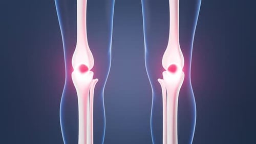 Human Knee Joint Animation Showing Pain and Inflammation