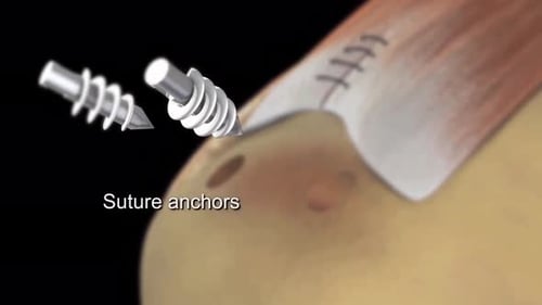 Close-up of sutured tendon fibers after surgery