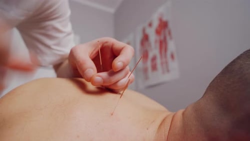 In einem Spa erhält ein Mann eine Akupunkturbehandlung am Rücken