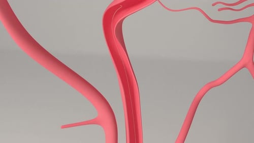 Medical catheter performing mechanical thrombectomy inside human cerebral artery model