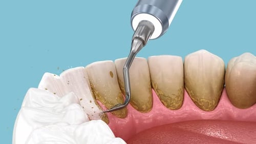 Teeth Cleaning Ultrasonic Scaling. Medically accurate 3D animation of human teeth treatment