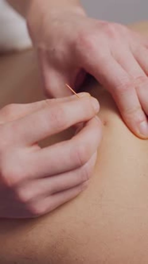 Akupunkturbehandlung, Nahaufnahme, Akupunkturnadeln, Hände des Arztes, die Akupunktur in die Haut des Patienten einarbeiten