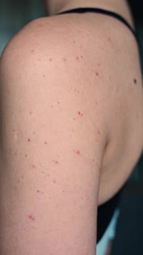 Hormonal Acne on Shoulder Skin in Adult Woman Skin Problems and Body Changes Due to Hormonal