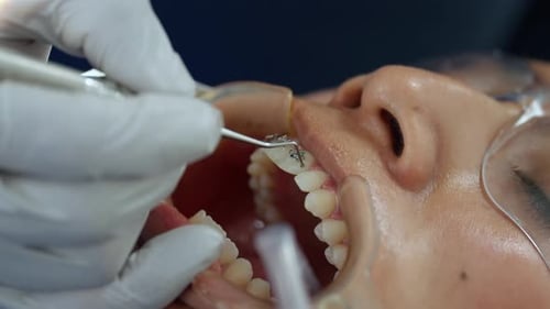 Ortodoncista mexicano cimenta un soporte metálico en el incisivo central maxilar