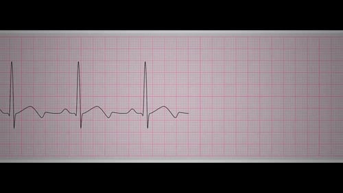 EKG-Grafik auf medizinischem Millimeterpapier, das die Herzaktivität zeigt