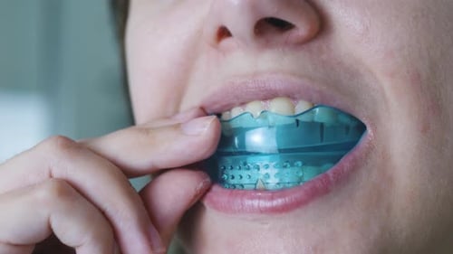 Woman Putting a Dental Aligner Orthodontic Night Guard on Her Teeth Close Up