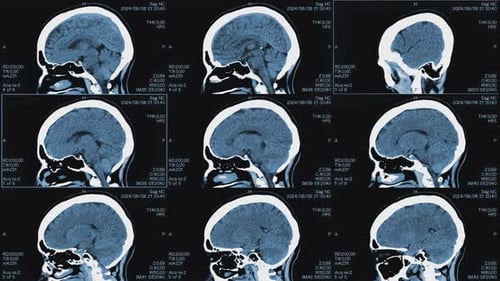 Magnetresonanzbilder des Kopfes, MRT der Gehirnseite und der Draufsicht eines Patienten mit mehreren