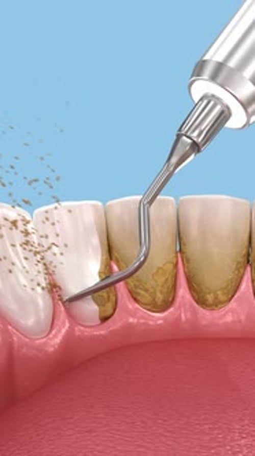 Oral hygiene: Scaling and root planing. 3D Animation ofconventional periodontal therapy
