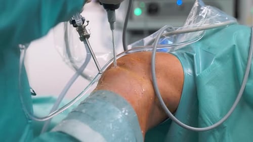 Knee Arthroscopy -Close-up. Surgeon Doctor Performs Restoration of Human Knee Joint.
