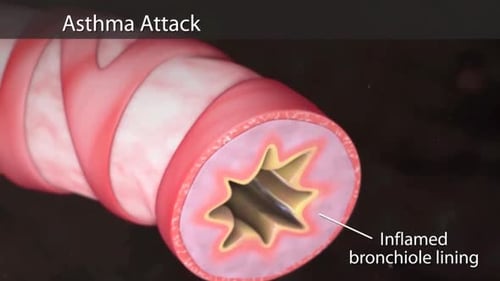 Ilustración médica que muestra una vía aérea estrecha durante un ataque de asma