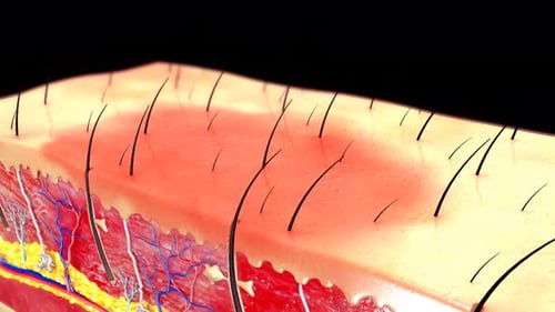 Detailed Medical Animation of Inflamed Human Skin Cross-Section