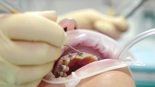 Un ortodoncista usa unos alicates para manipular un delgado arco de alambre durante el ajuste de los aparatos dentales, manos enguantadas