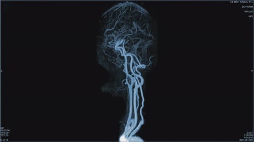 Magnetic Resonance Images of the Brain MRI of the Brain of a Patient with Multiple Vascular