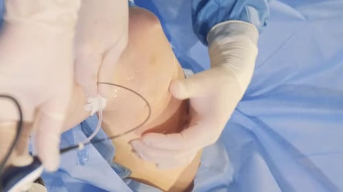 Opération chirurgicale sur les veines des jambes : ablation endoveineuse, sclérothérapie et ablation veineuse (vidéo verticale)