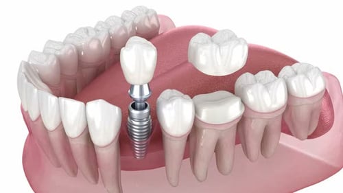 Dental Implant and Bridge Procedure 3D Animation