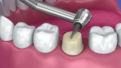 Dental Crown Preparation and Installation 3D Animation