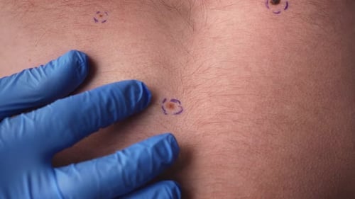 Arzt untersucht markierten Maulwurf am männlichen Torso