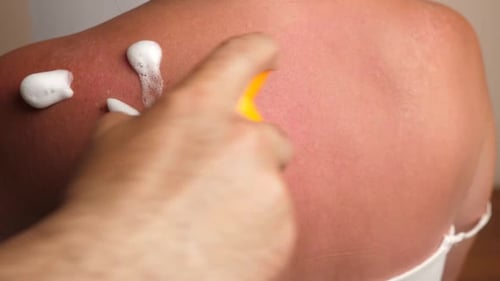 04, La mousse est appliquée sur les zones de la peau endommagées par le soleil. Coups de soleil sur la peau. Soin de la peau du corps
Port