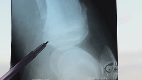 Shoulder Joint X-ray Examined with Pen