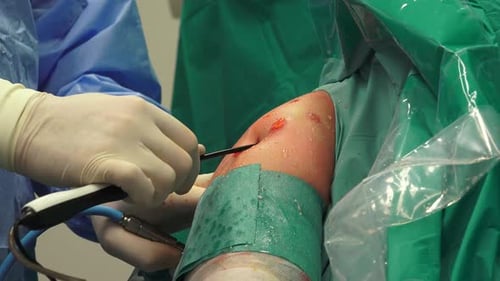 Surgeon Performing Knee Arthroscopy in Hospital