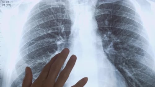 X-Ray of Ribs Picture being Examined by Doctor's Hand - Closeup Detailed Shot